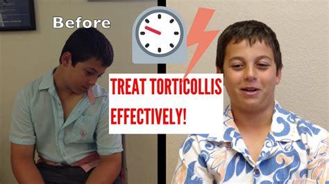 Effective Torticollis Treatment! (INCREDIBLE RESULTS!!) - YouTube