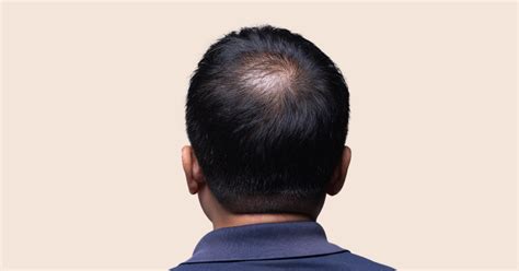 Alopecia Hair Loss Types And Treatment Options Andsons Sg