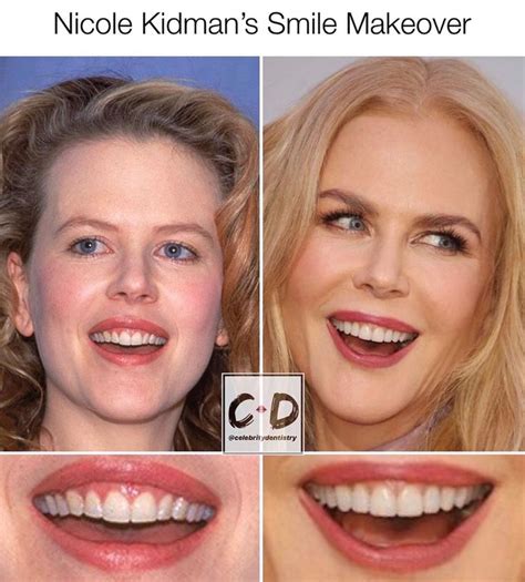 Celebrity 👄 Dentistrys Instagram Profile Post Nicole Kidmans Smile