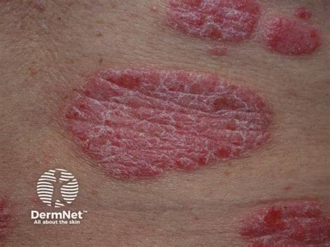 Chronic Plaque Psoriasis Images Dermnet