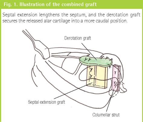 Figure 1 From Correction Of Short Nose Deformity Using A Septal