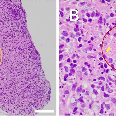 Histopathological Section Of A Core Needle Biopsy Of Left Cervical Download Scientific Diagram