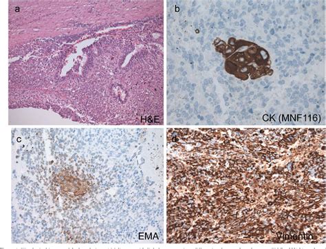 Biphasic Pulmonary Blastoma Semantic Scholar