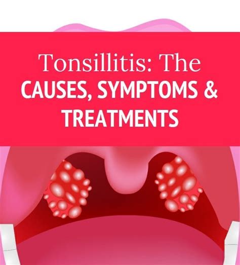 Tonsillitis, cause, symptoms and treatment? | V.L. Makabali Memorial ...