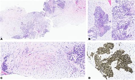 Desmoplastic Small Round Cell Tumor Of The Pleura With Brain Metastasis