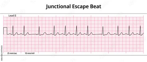 ECG Junctional Escape Beat - 8 Second ECG Paper - Electrocardiogram ...