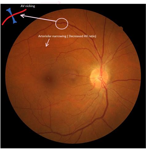 Hypertensive Retinopathy Statpearls Ncbi Bookshelf