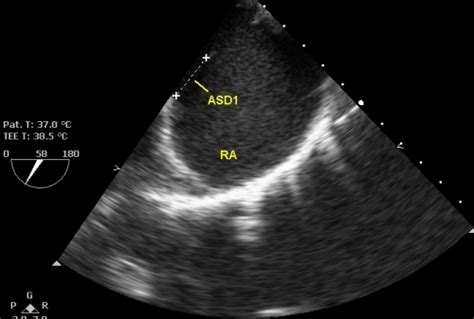 Transesophageal echocardiogram in atrial septal defect – Echocardiogram ...