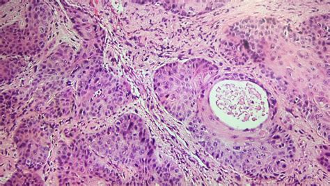 Squamous Cell Carcinoma Of Oral Cavity