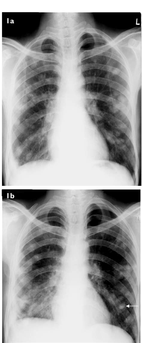 Chest Radiograph Posteroanterior View Taken A Pretreatment Shows