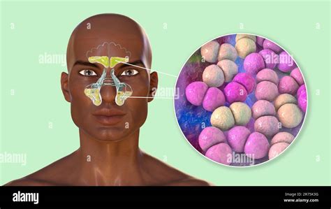 Bacterial Sinusitis Computer Illustration The Sinuses Are Membrane