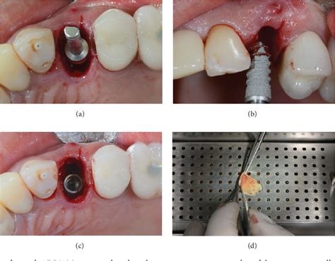 Pdf 3d Printingadditive Manufacturing Single Titanium Dental