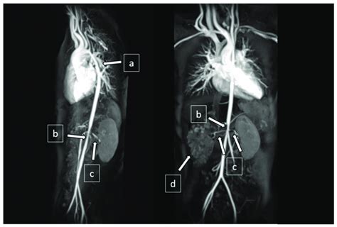 Magnetic Resonance Angiography Mra Showed A Narrowing At The Distal Download Scientific