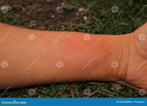 Skin Allergy Yellow Wasp Stung By A Wasp Worker Hornet Stings A Man