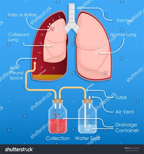 237 Chest Tube Drainage Images Stock Photos And Vectors Shutterstock