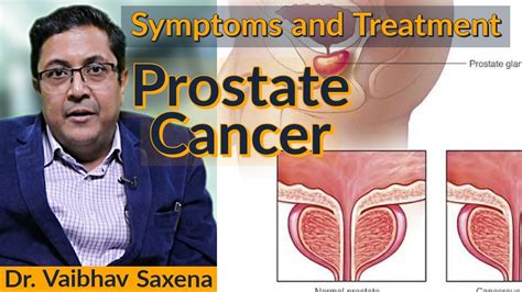 Prostate Cancer Symptoms Early Detection And Treatment Youtube