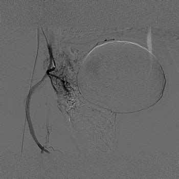 Embolizaci N De Las Arterias Prost Ticas Centro Gil Vernet De Urolog A