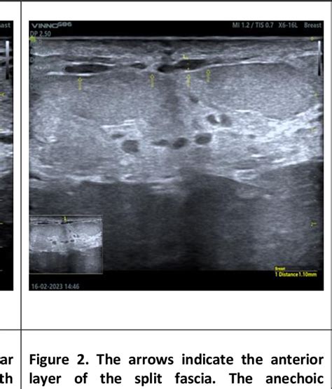 Figure 1 From Clinical And Ultrasound Features Of Mondor S Disease Of The Breast A Case Series