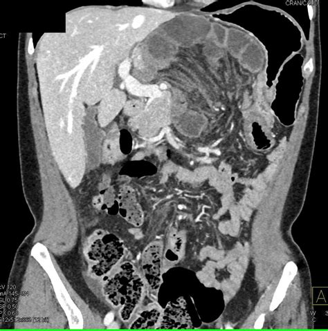 Internal Hernia With Midgut Volvulus With Small Bowel Obstruction And