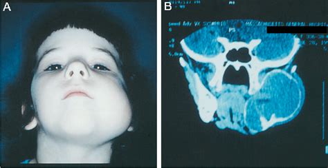 Figure 1 From Antiangiogenic Therapy Of A Recurrent Giant Cell Tumor Of The Mandible With