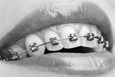 Dental Braces Orthodontic Treatment And Services