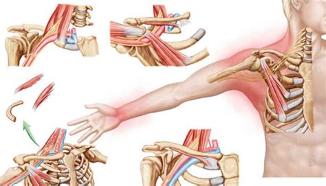 Thoracic Outlet Syndrome Inspirationi