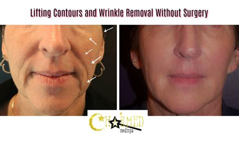 The Powerful Combination Of Fillers And Sculptra Charmed Medispa