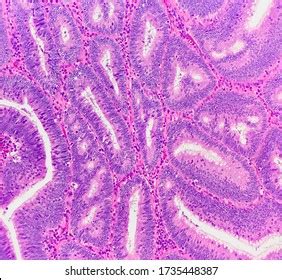 Tubular Adenoma Royalty Free Images Stock Photos Pictures Shutterstock