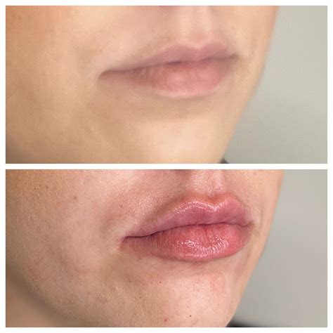 B A 10 RHA 3 Lip Filler Saintly Skin