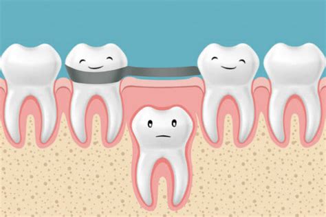 Odontopediatría Los Mantenedores De Espacio