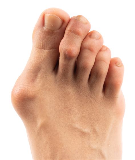 Bunions: Causes, Types, and Treatments | Canyon Oaks Foot & Ankle