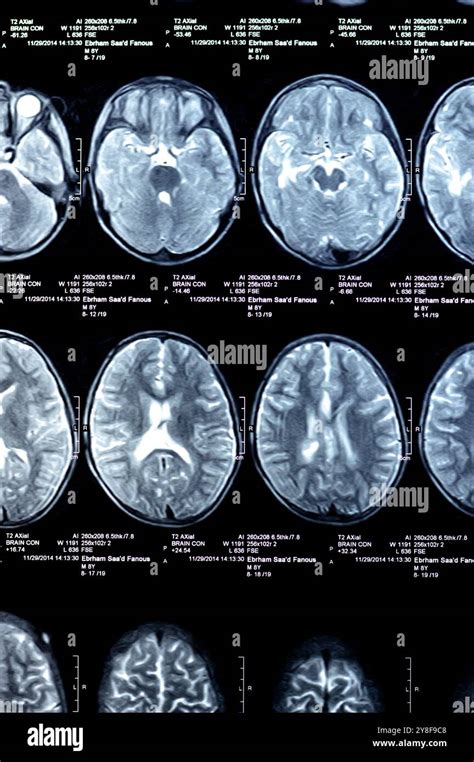 Cairo, Egypt, September 26 2024: MRI brain reveals functioning intra ...