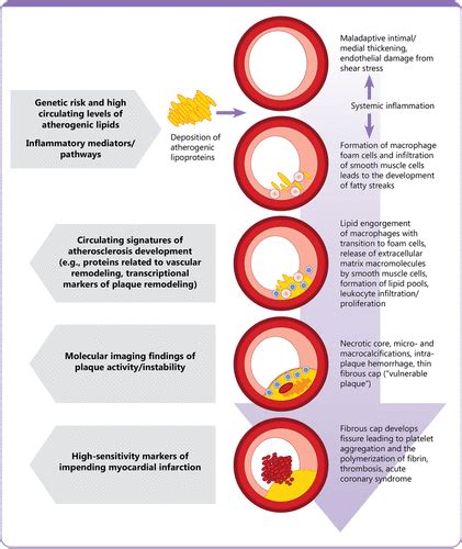 Illustrates The Progression Of Atherosclerosis In Cvd