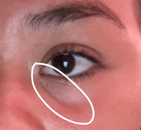 Whats This Line Under My Eye Can I Get Rid Of It Rskincareaddiction