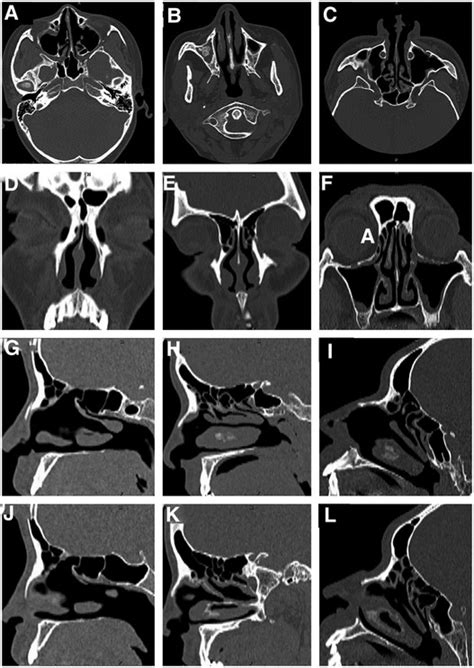 Frontiers Case Report Endoscopic Frontal Sinus Opening Surgery For