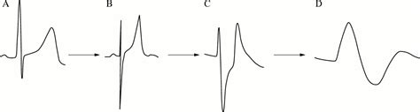 Sine Wave Hyperkalemia Ecg Changes