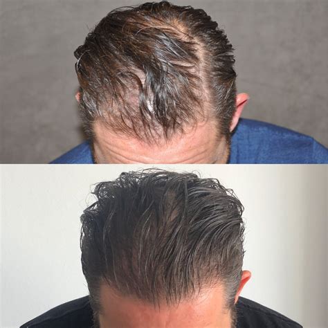 Hair Transplant Hairline Lowering Before Afters Beverly Hills