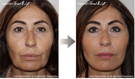 Photos résultats Lifting Infinite Thread Thread Lift