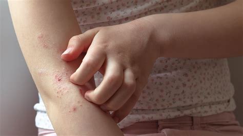 Is Eczema An Autoimmune Disease Causes Symptoms And Treatment Goodrx