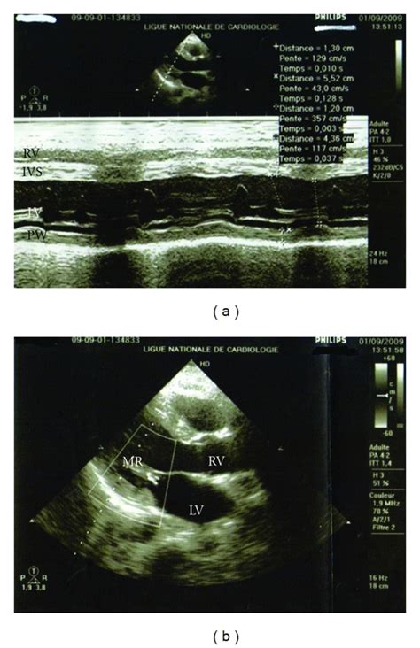 A Echocardiographically Parasternal Long Axis Depicted Improvement Of