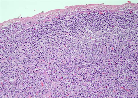 Benign Lymphoepithelial Lesion