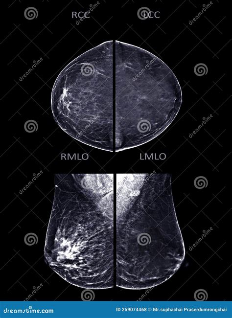 X Ray Digital Mammogram Or Mammography Of Both Side Breast Standard