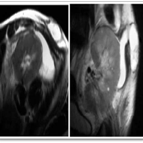 Ultrasound scanning showing dilatation of the pelvi-calyceal system and... | Download Scientific ...