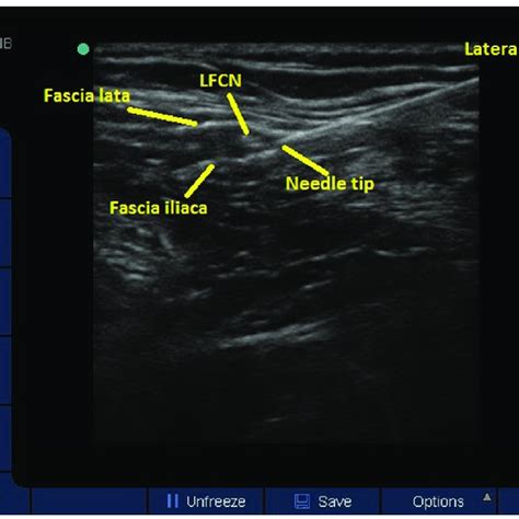 Lateral Femoral Cutaneous Nerve Block