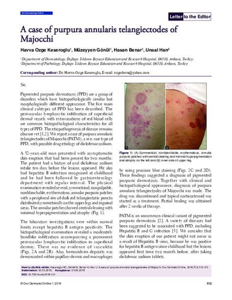 Pdf A Case Of Purpura Annularis Telangiectodes Of Majocchi