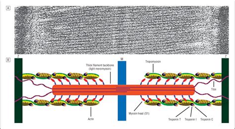 Figure 1 From Embryonic Myosin Heavy Chain Mutations Cause Distal