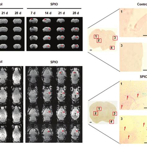 Tracing Of Transplanted NSCs Labeled With SPIO In TMCAO Mice A