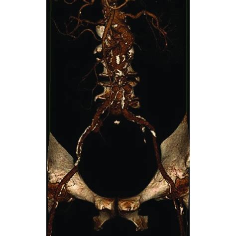 Three Dimensional Reconstruction Of Computed Tomography Angiography