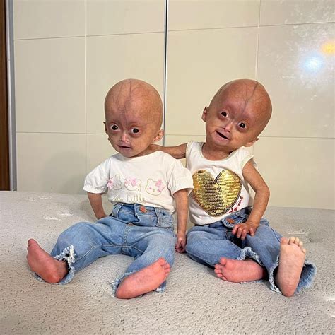 Qual É A Doença Mais Rara Do Mundo - Doencas Muito Raras Dia Mundial Das Doenças Raras Destaca O Tema