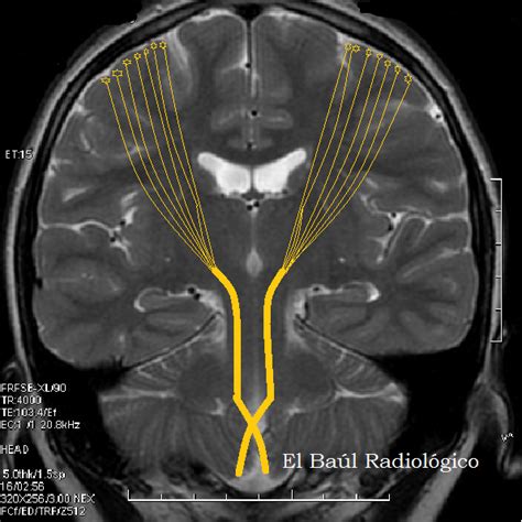El Baúl Radiológico Esclerosis Lateral AmiotrÓfica Hallazgos En TomografÍa Por Resonancia